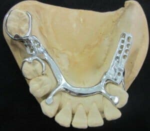 Cast Partial Frameworks | Baluke | Dental Studios