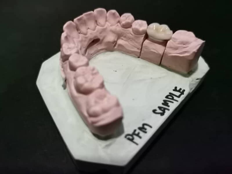 Dental Crown - GTC Dental Ipoh Garden