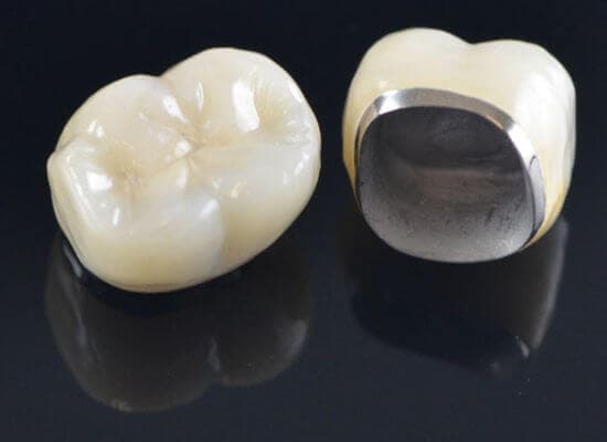 Porcelain Fused To Metal Dental Crown in Toronto - Atlas Dental