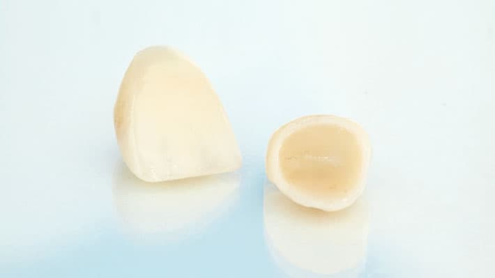 Tips to Help You Maintain Your Porcelain Dental Crown - Dr. Karen Kang ...