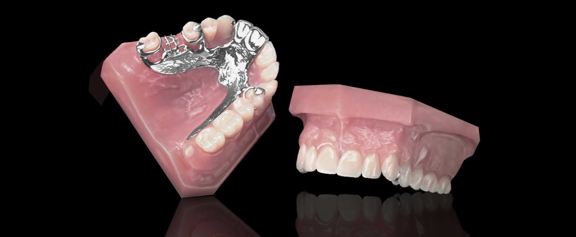 Top 5 Cast Metal Partial Dentures in Canada 2026