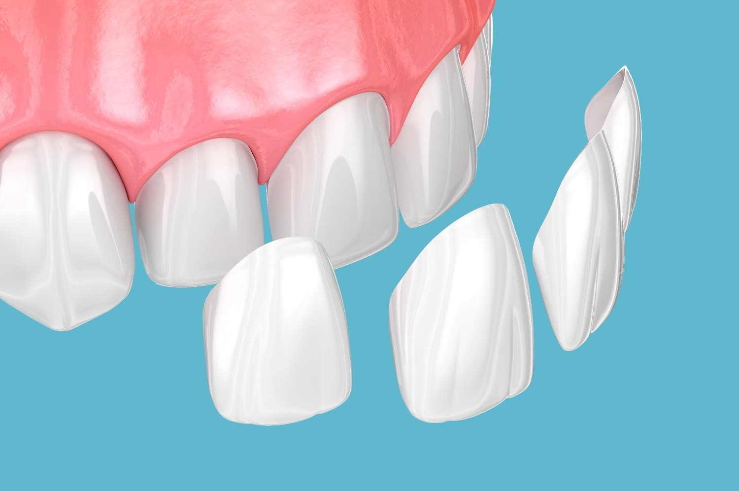 Porcelain Veneers | Achieve a Flawless, Natural Smile