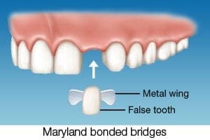 Maryland Bonded Bridges - Costa Rica Dental Guide to Best Dentists