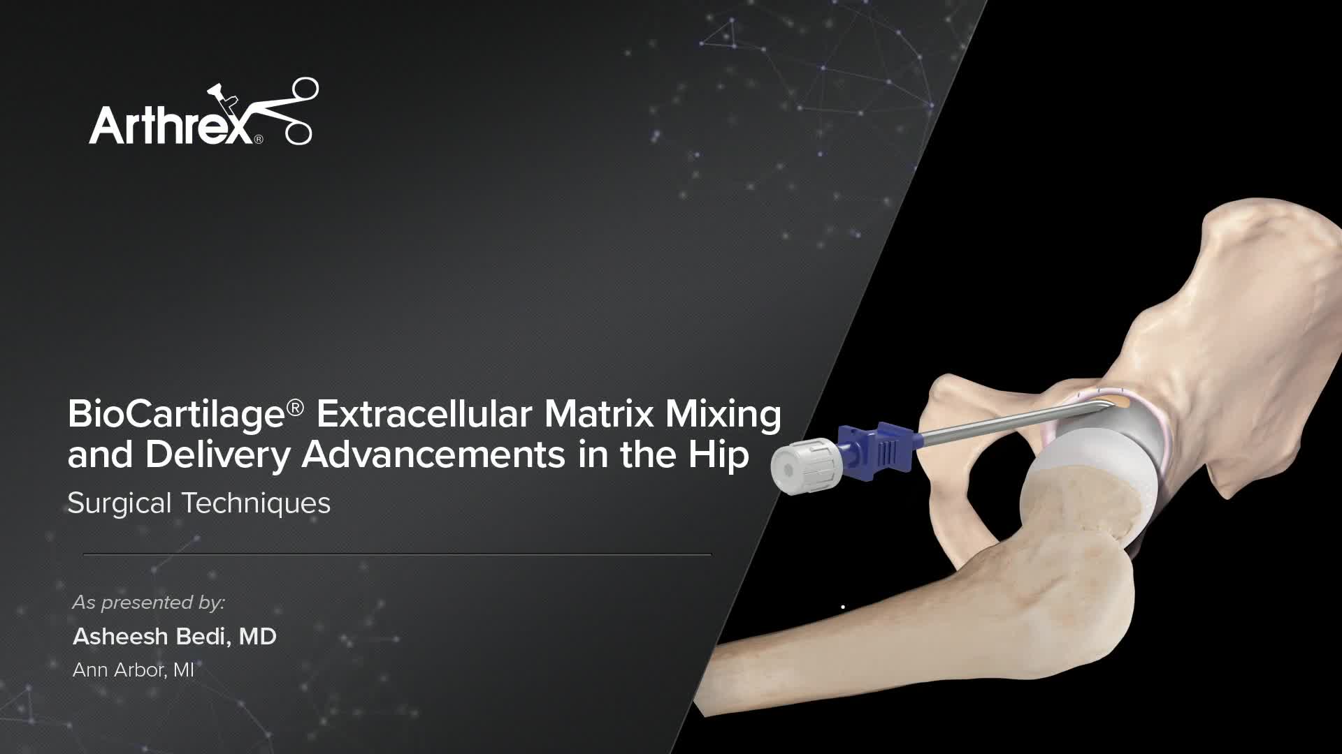 Arthrex - BioCartilage® Extracellular Matrix Mixing and Delivery ...