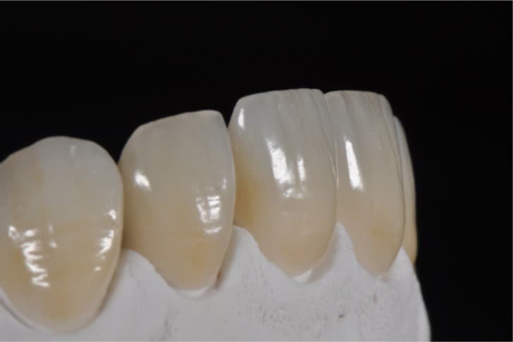 Minimally invasive veneers: current state of the art - PMC