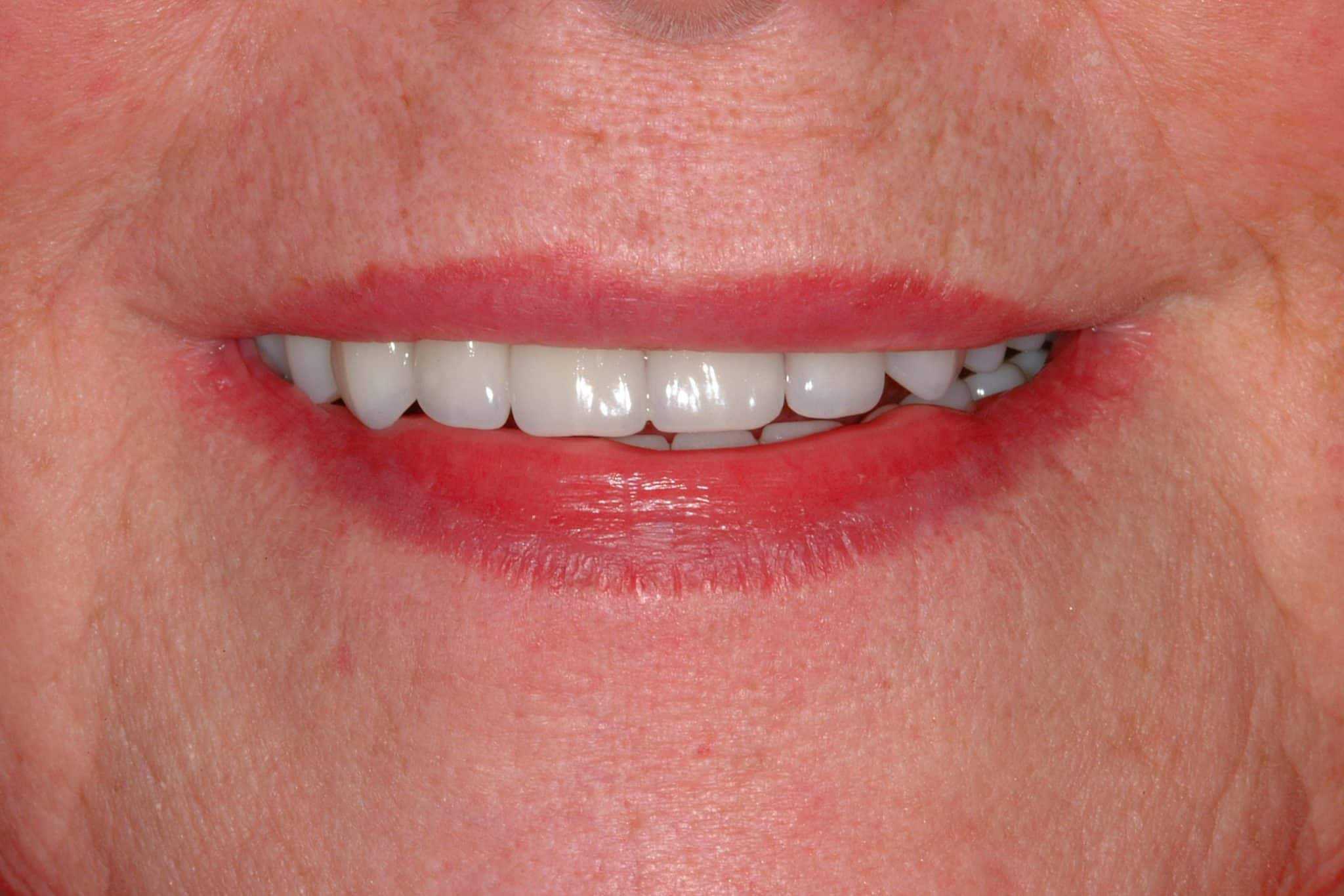 Implant Overdenture - Munoz Family and Cosmetic Dentistry
