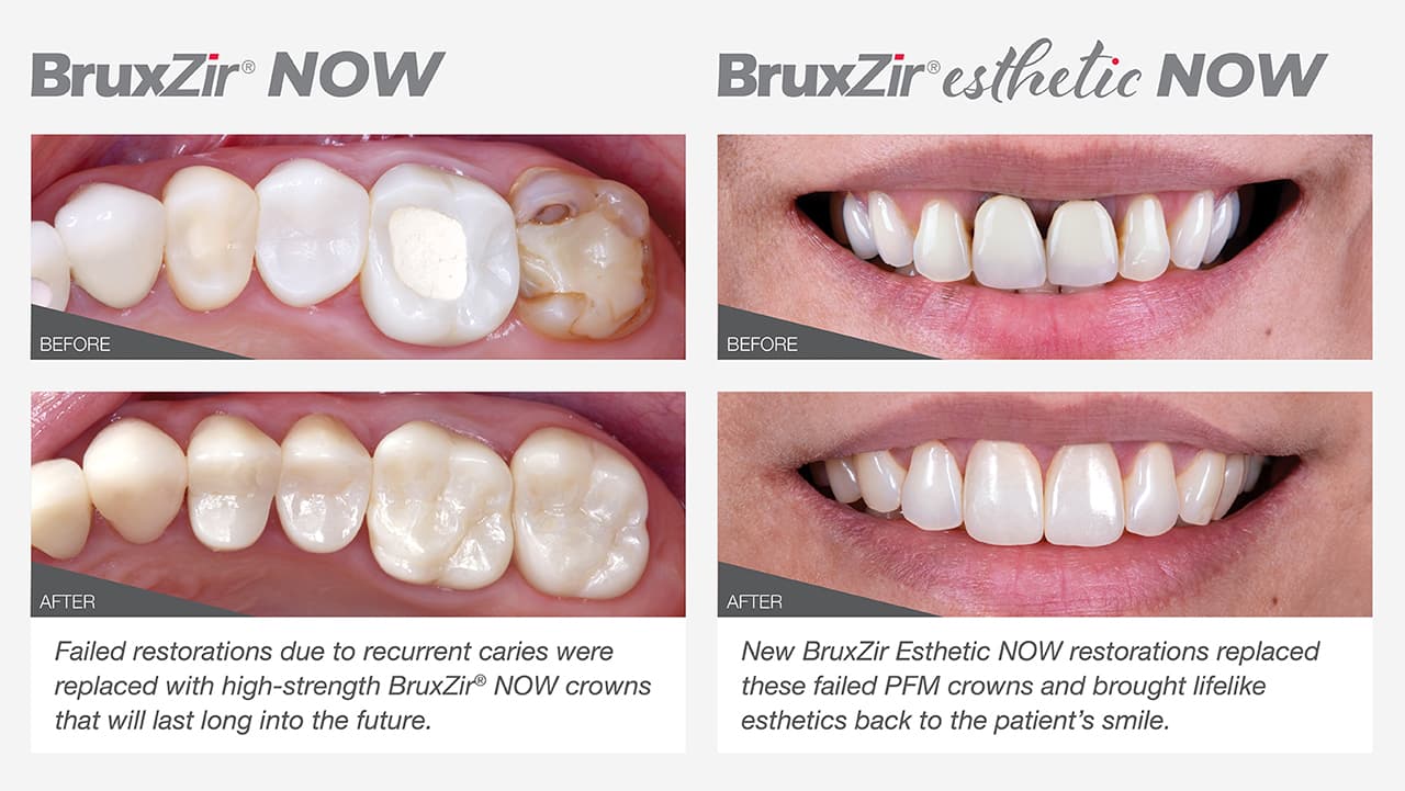 The glidewell.io™ Advantage: Same-Visit BruxZir® Crowns