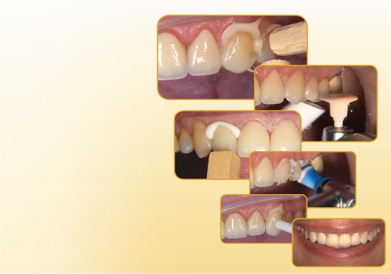 Anterior Procera Zirconia Crowns with No-Prep Vivaneers
