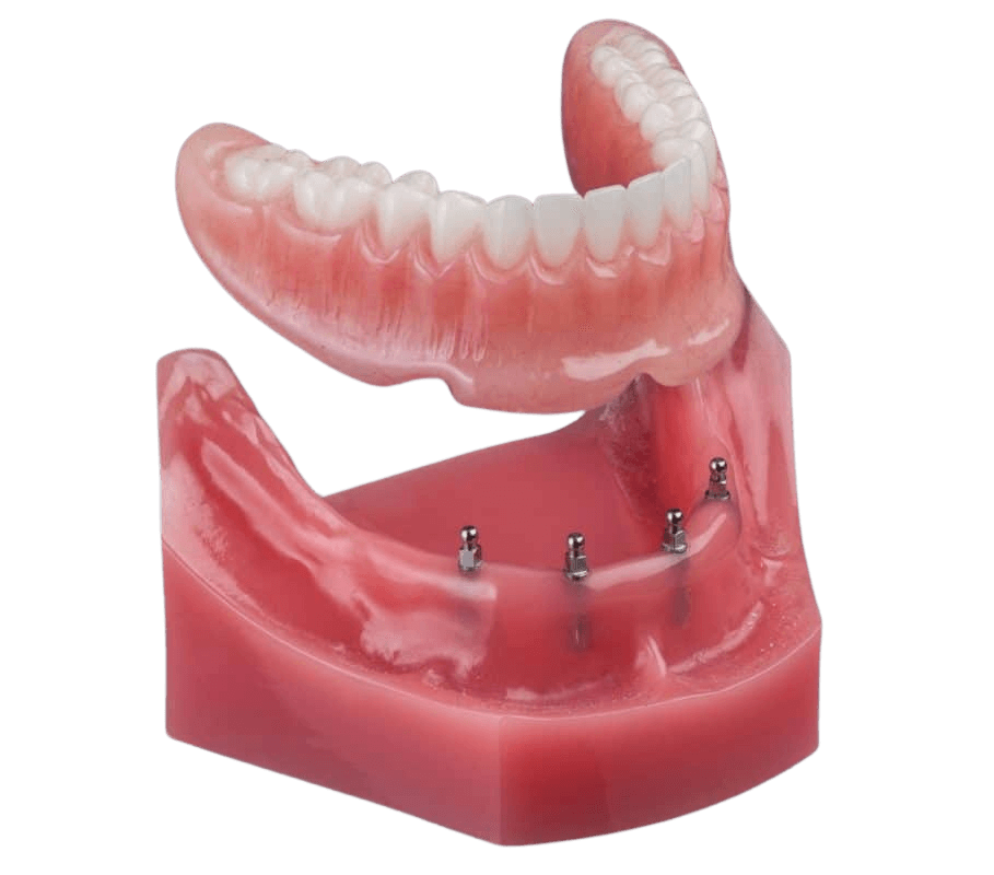 Mini Implant Dentures in Gulfport, MS | Book a Free Consultation