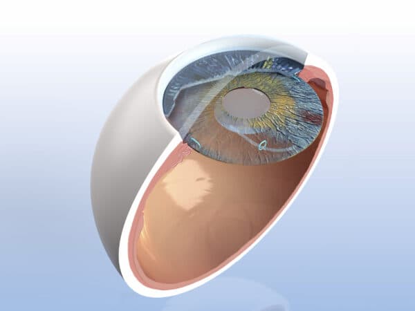 CUSTOMFLEX® ARTIFICIALIRIS by Human Optics - Kestrel Ophthalmics