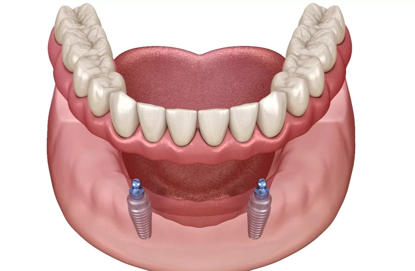 Implant Dentistry Darien IL - Overdentures at Kingery Dental Health and ...