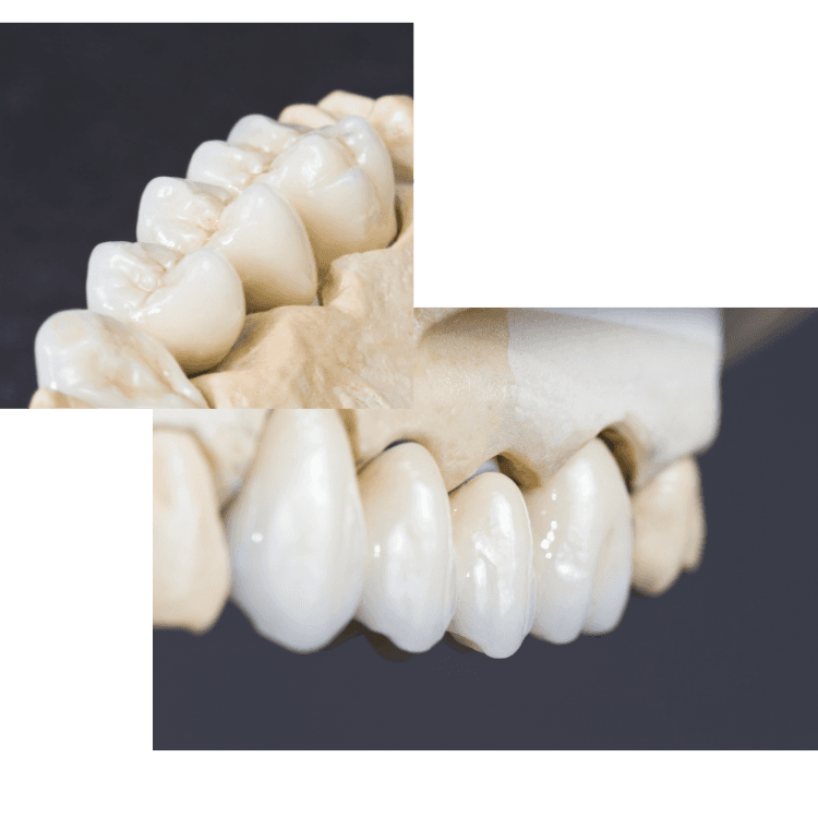 Bridges – Spinney Brook Dental Practice