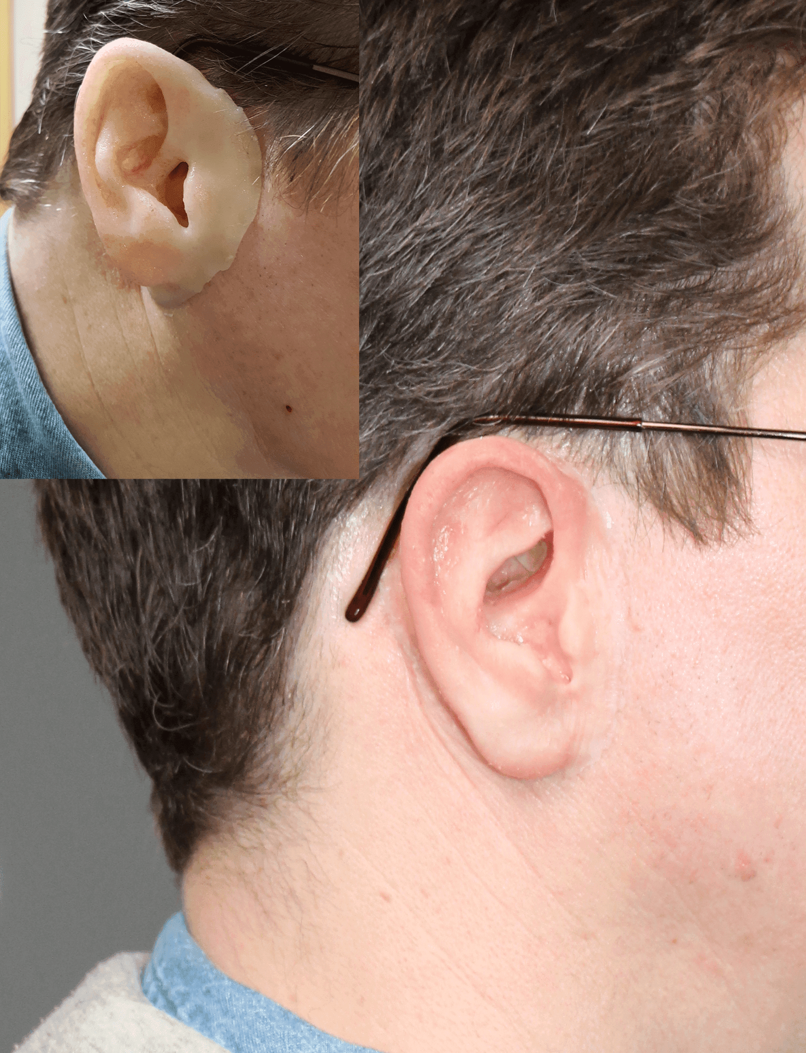 Auricular/ear prosthetics are hand sculpted and hand made for each patient