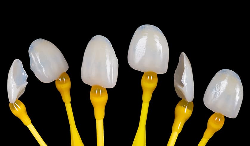 Durathin Veneers – Baker Street Dental