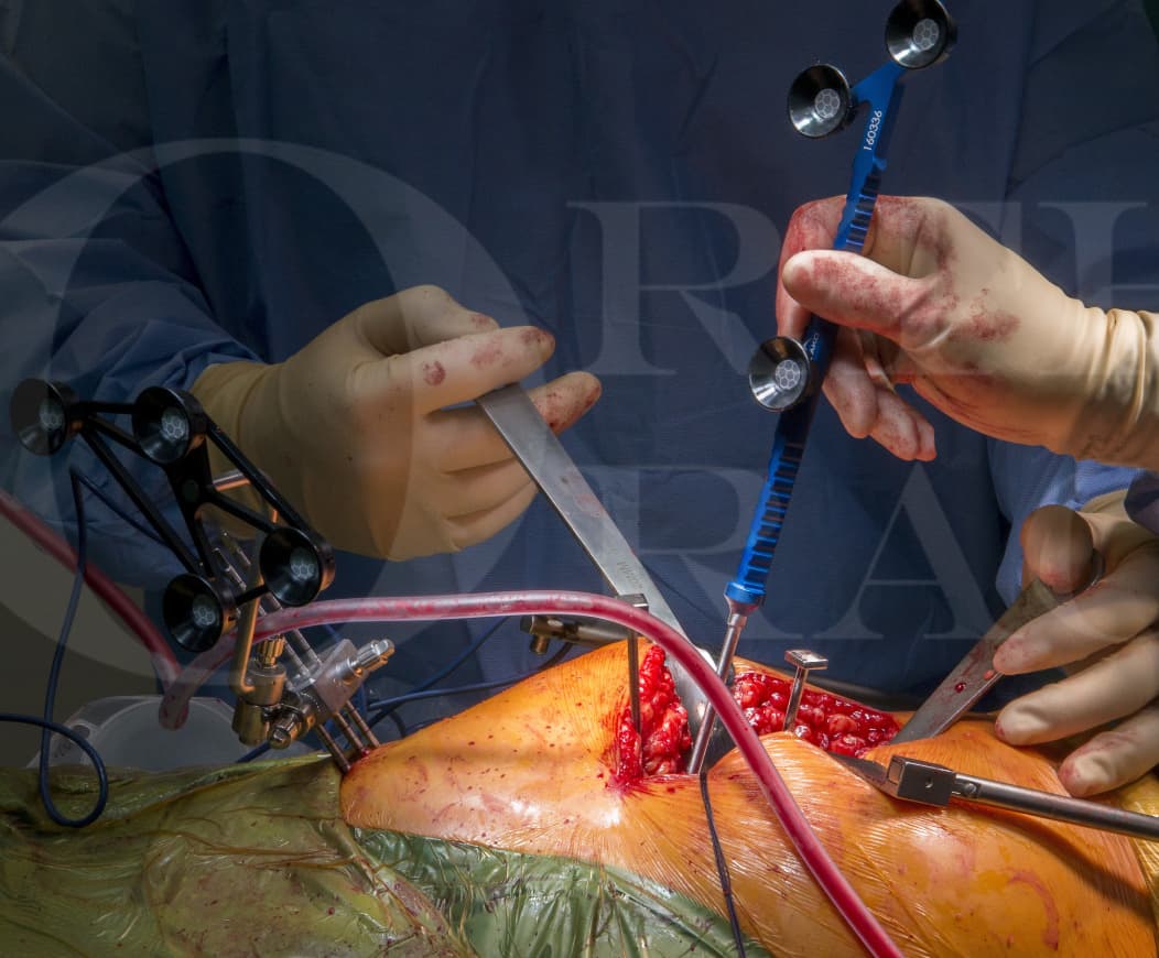 Remplacement total de la hanche : Stryker MAKO robotisé avec ...