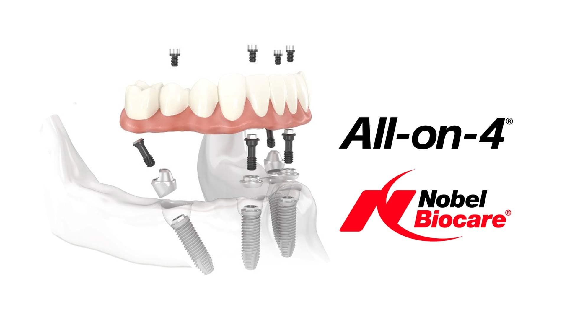 L’AUTENTICO ALL-ON-4® È SOLO NOBEL BIOCARE | Studio Odontoiatrico ...